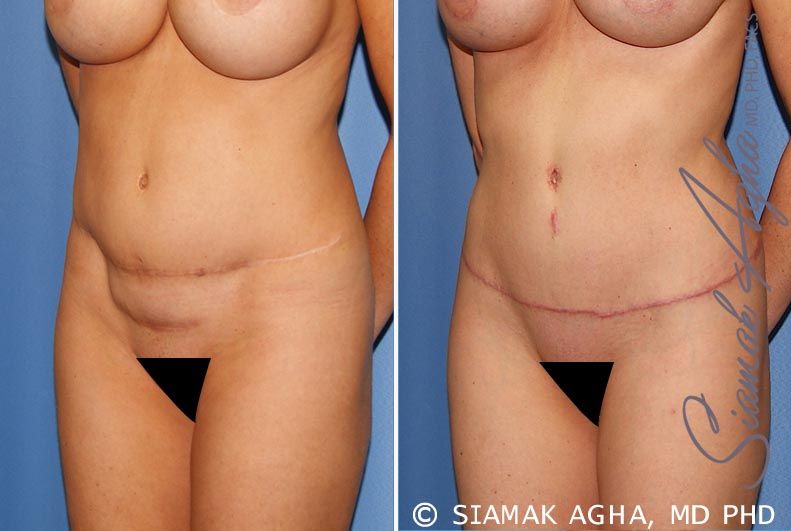 Tummy Tuck Revision Before & After
