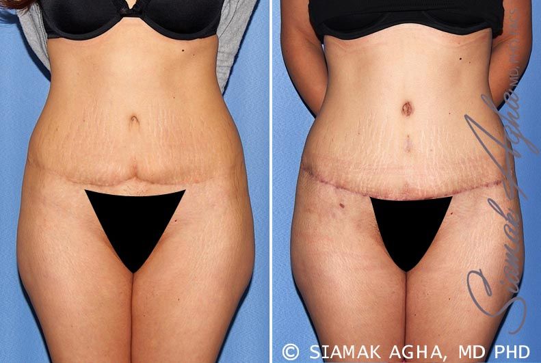 Tummy Tuck Revision Before & After