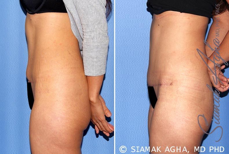 Tummy Tuck Revision Before & After