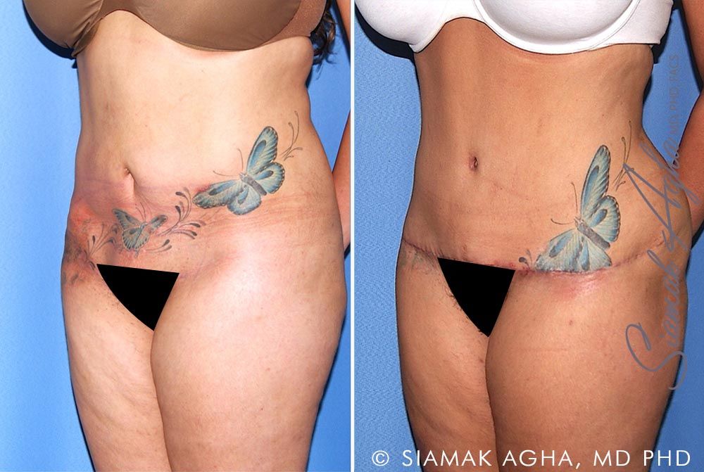 Tummy Tuck Revision Before & After