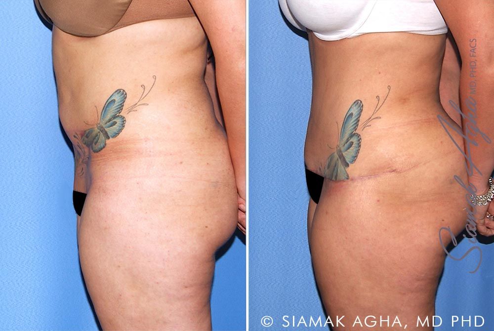 Tummy Tuck Revision Before & After