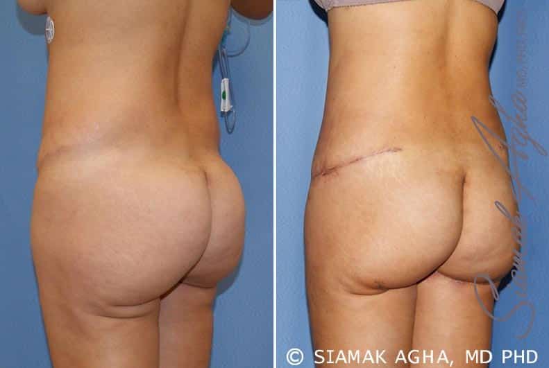 Tummy Tuck Revision Before & After