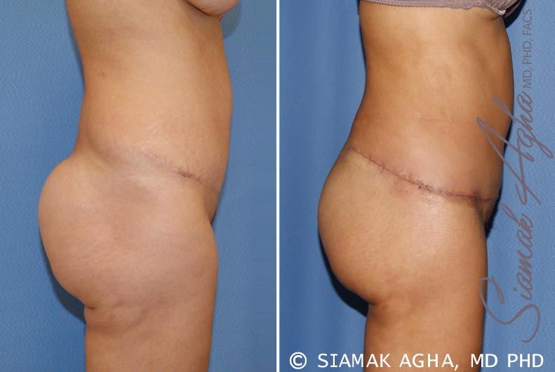 Tummy Tuck Revision Before & After