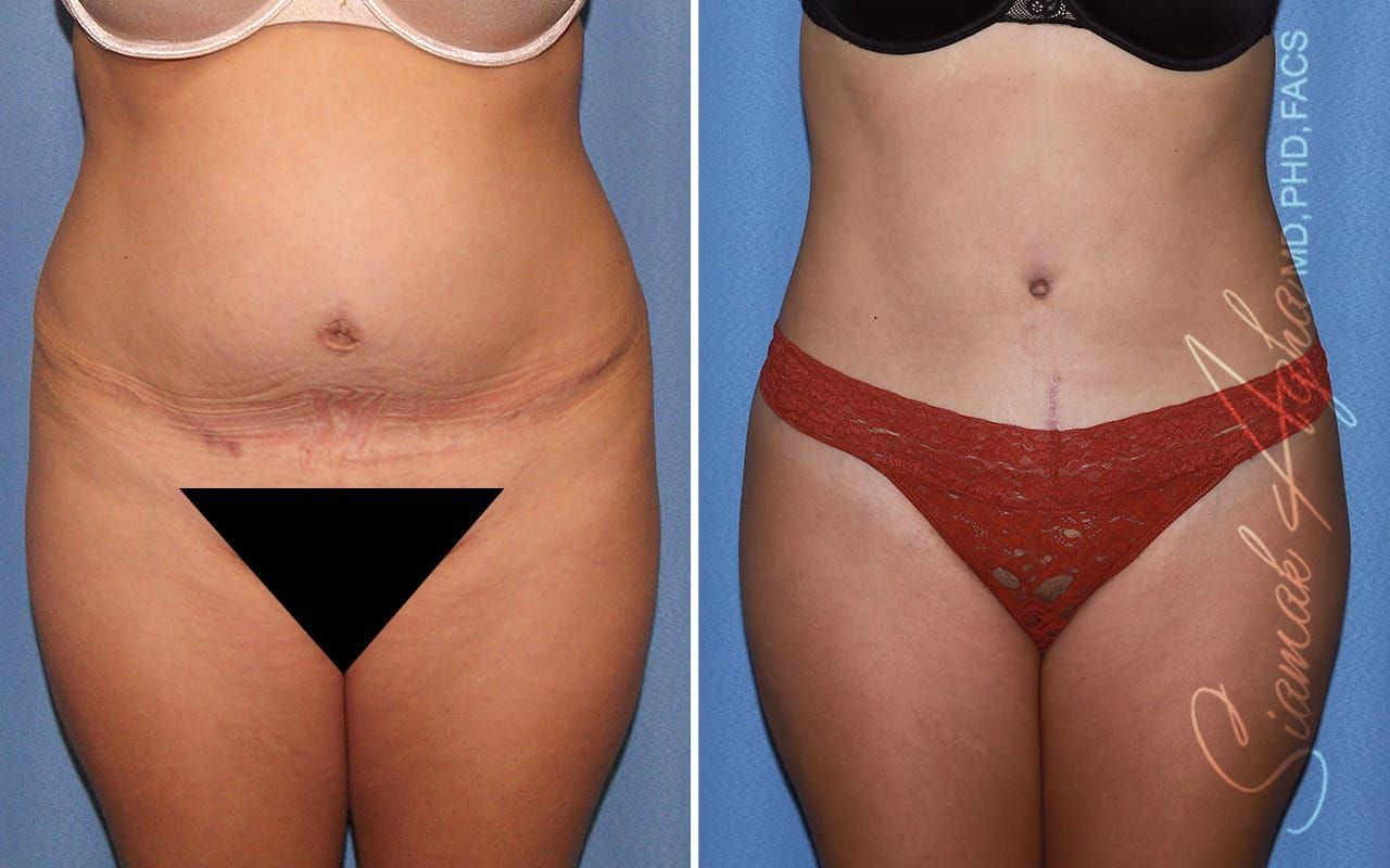 Tummy Tuck Revision Before & After