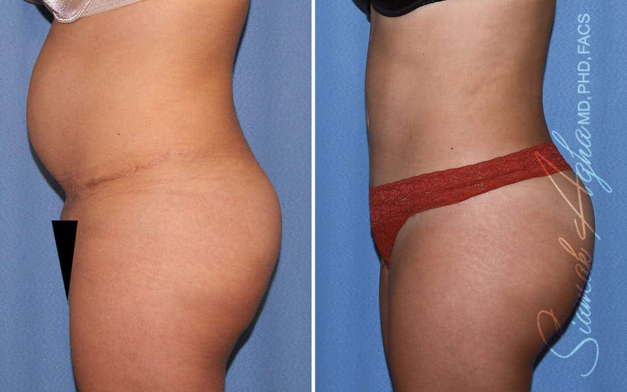 Tummy Tuck Revision Before & After