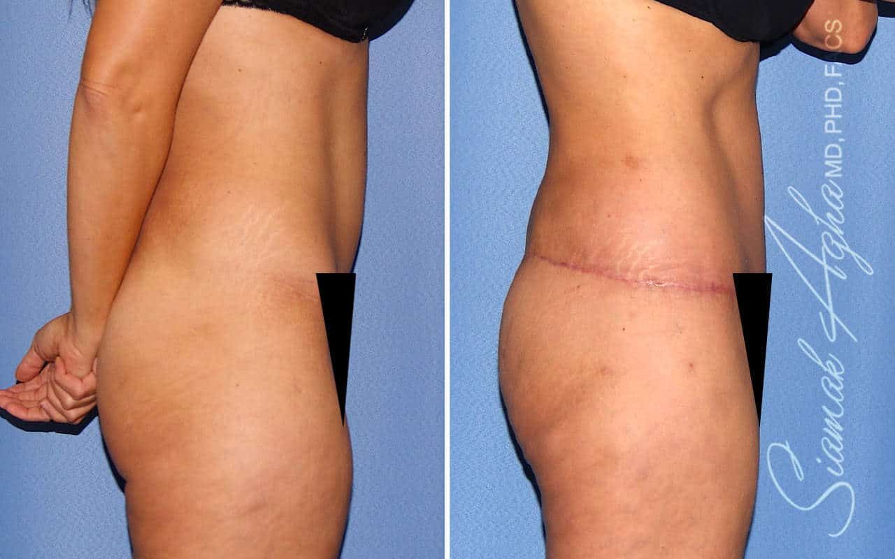 Tummy Tuck Revision Before & After