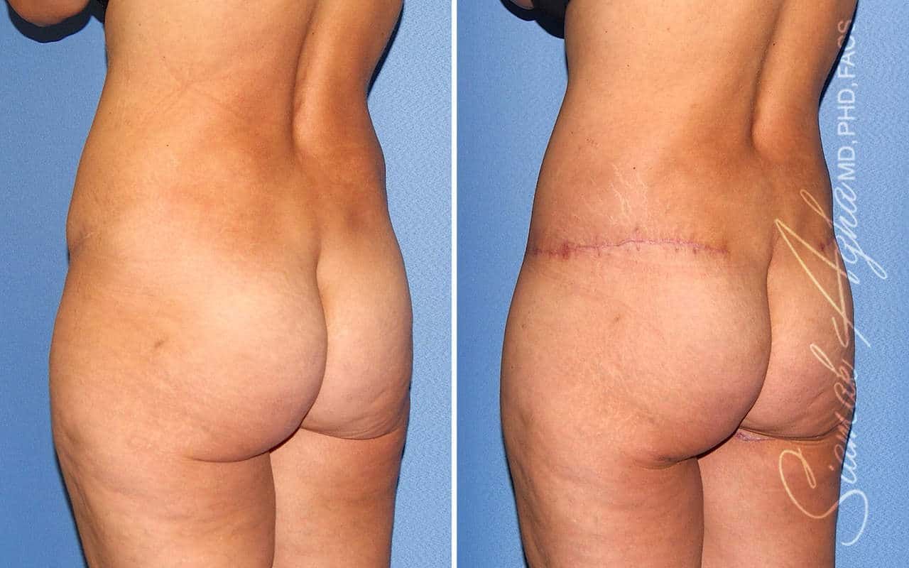 Tummy Tuck Revision Before & After