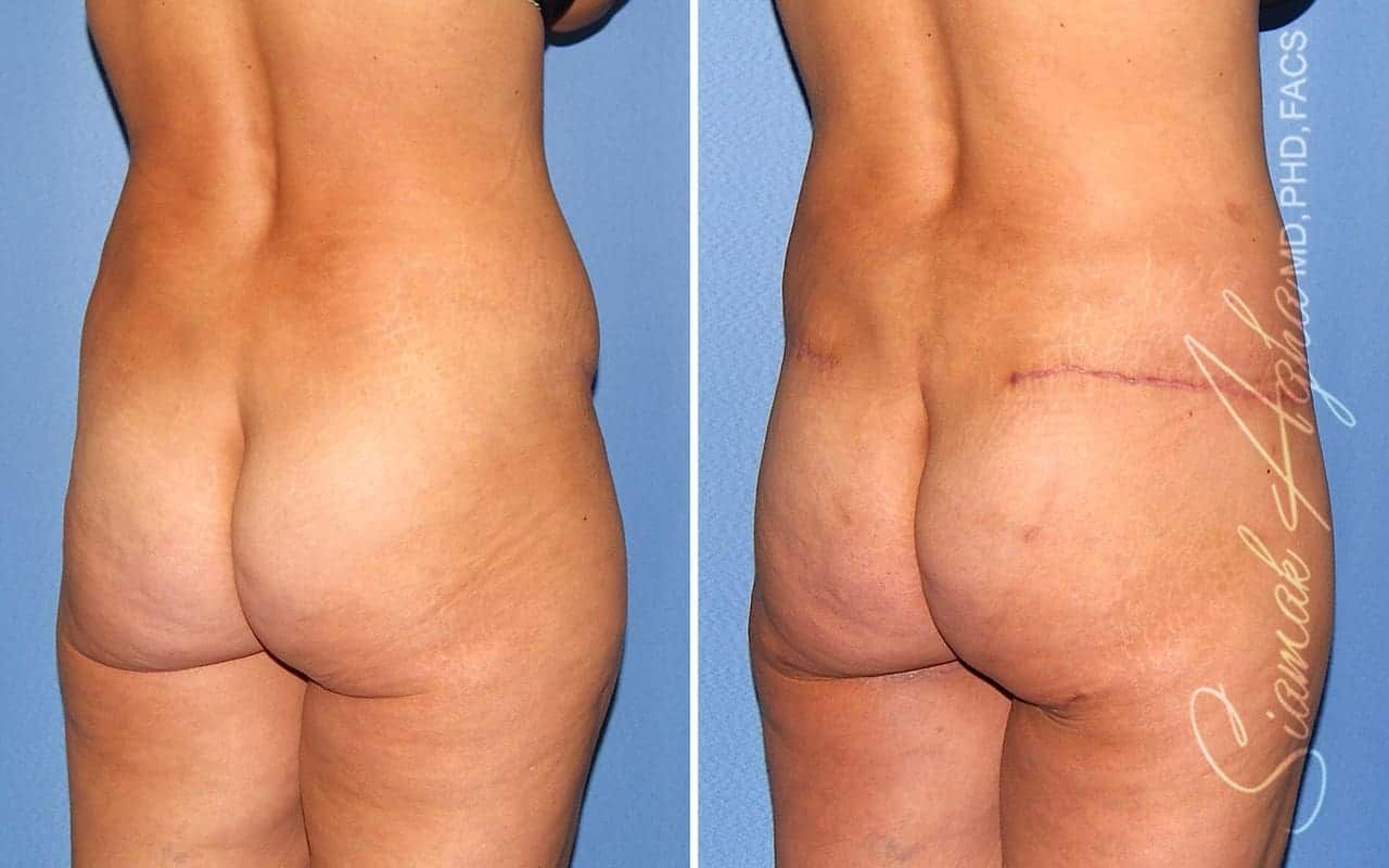 Tummy Tuck Revision Before & After