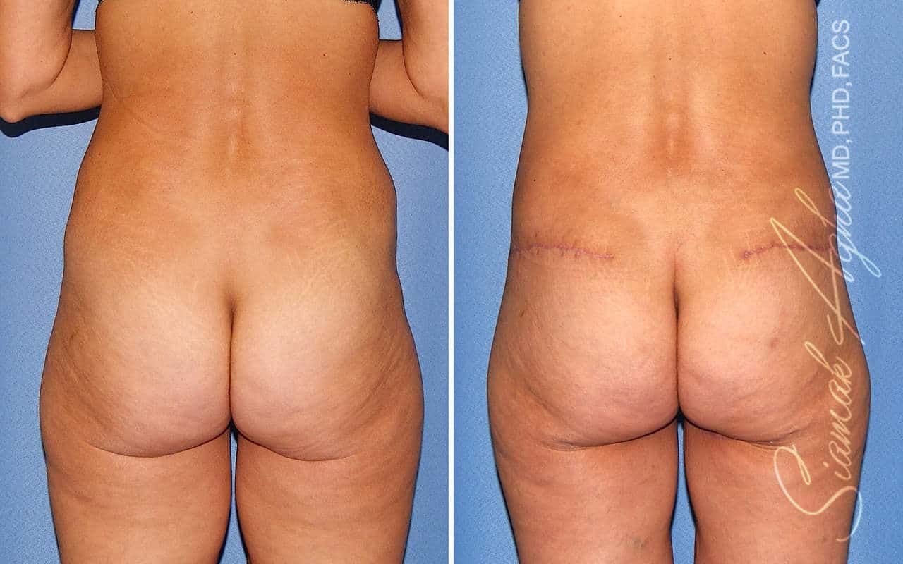 Tummy Tuck Revision Before & After