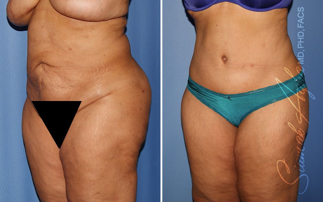 Tummy Tuck Revision Before & After