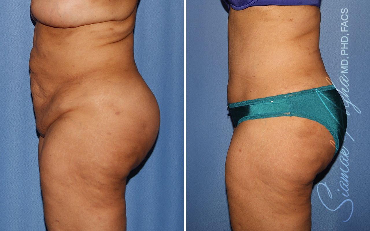 Tummy Tuck Revision Before & After