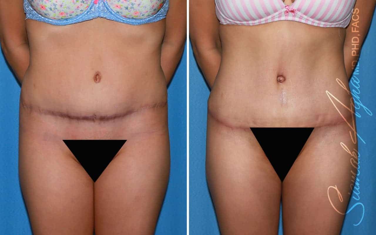 Tummy Tuck Revision Before & After