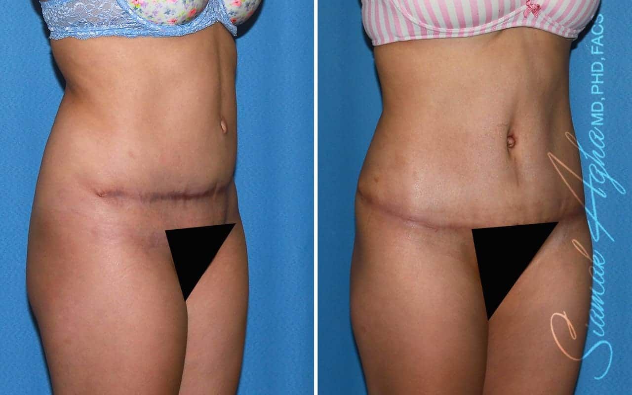 Tummy Tuck Revision Before & After