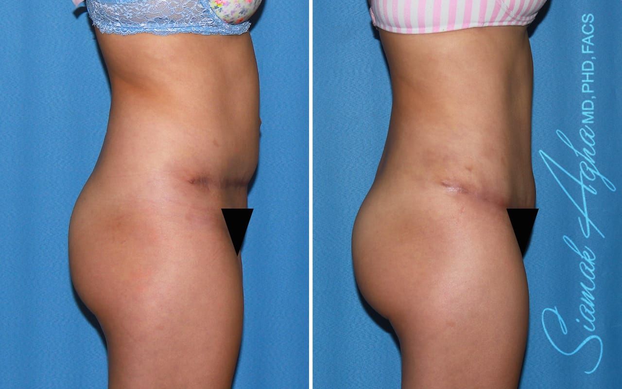 Tummy Tuck Revision Before & After