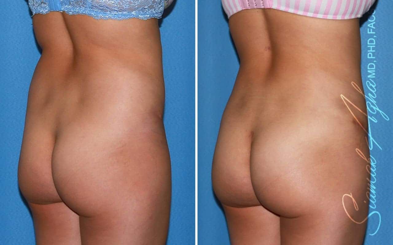 Tummy Tuck Revision Before & After