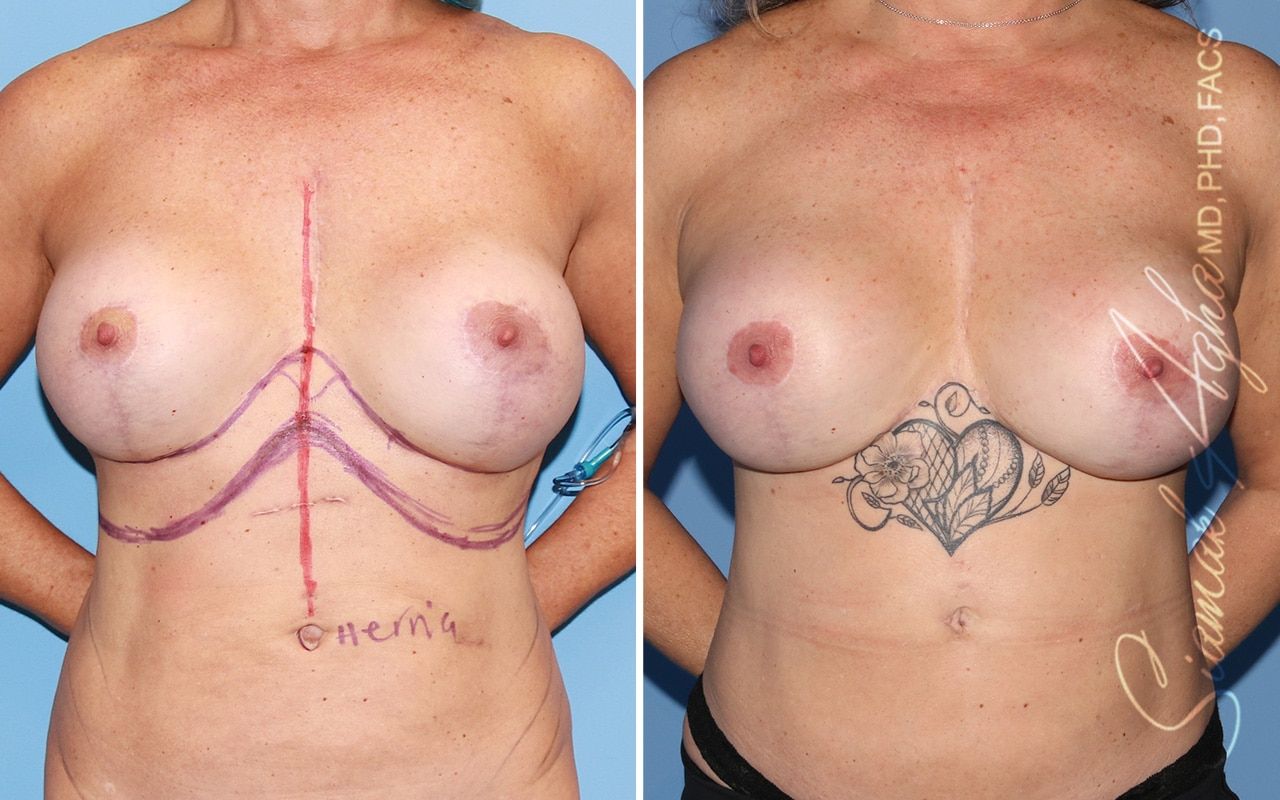Reverse Tummy Tuck Before & After