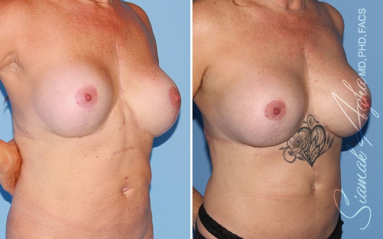 Reverse Tummy Tuck Before & After