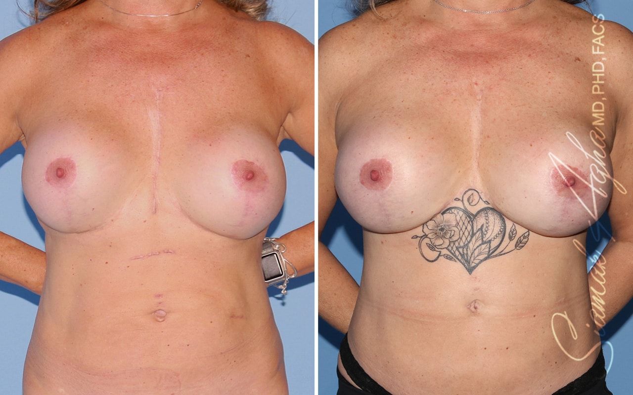 Reverse Tummy Tuck Before & After