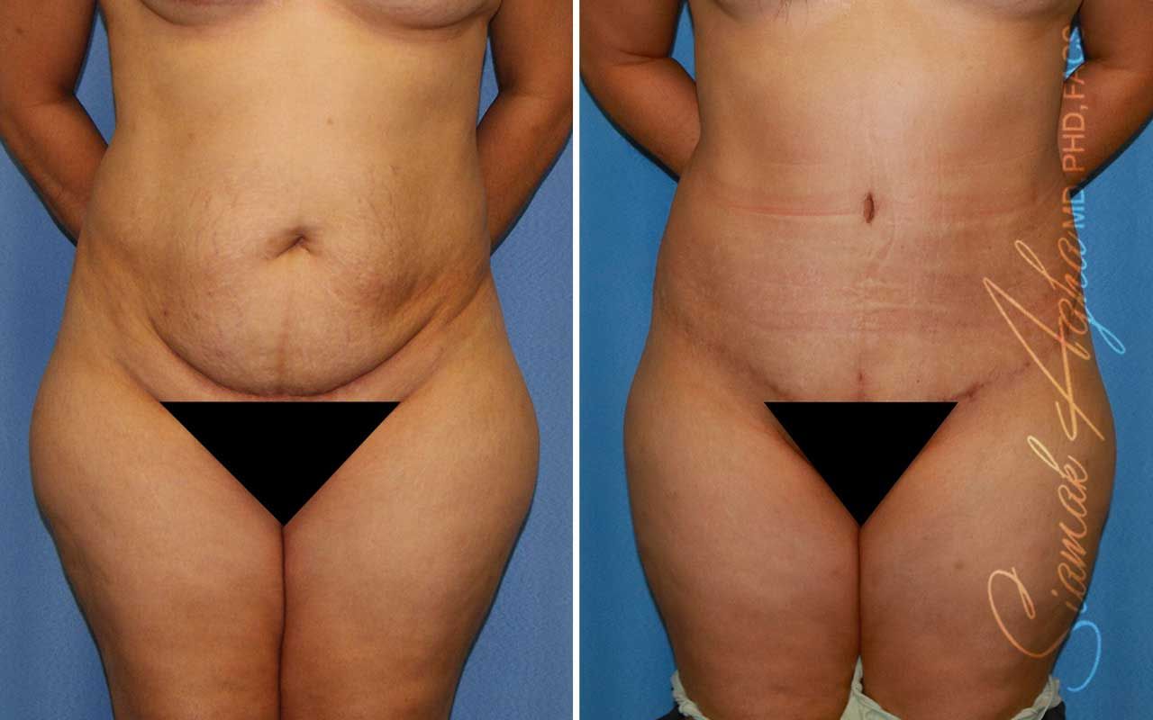 Partial Tummy Tuck Before & After