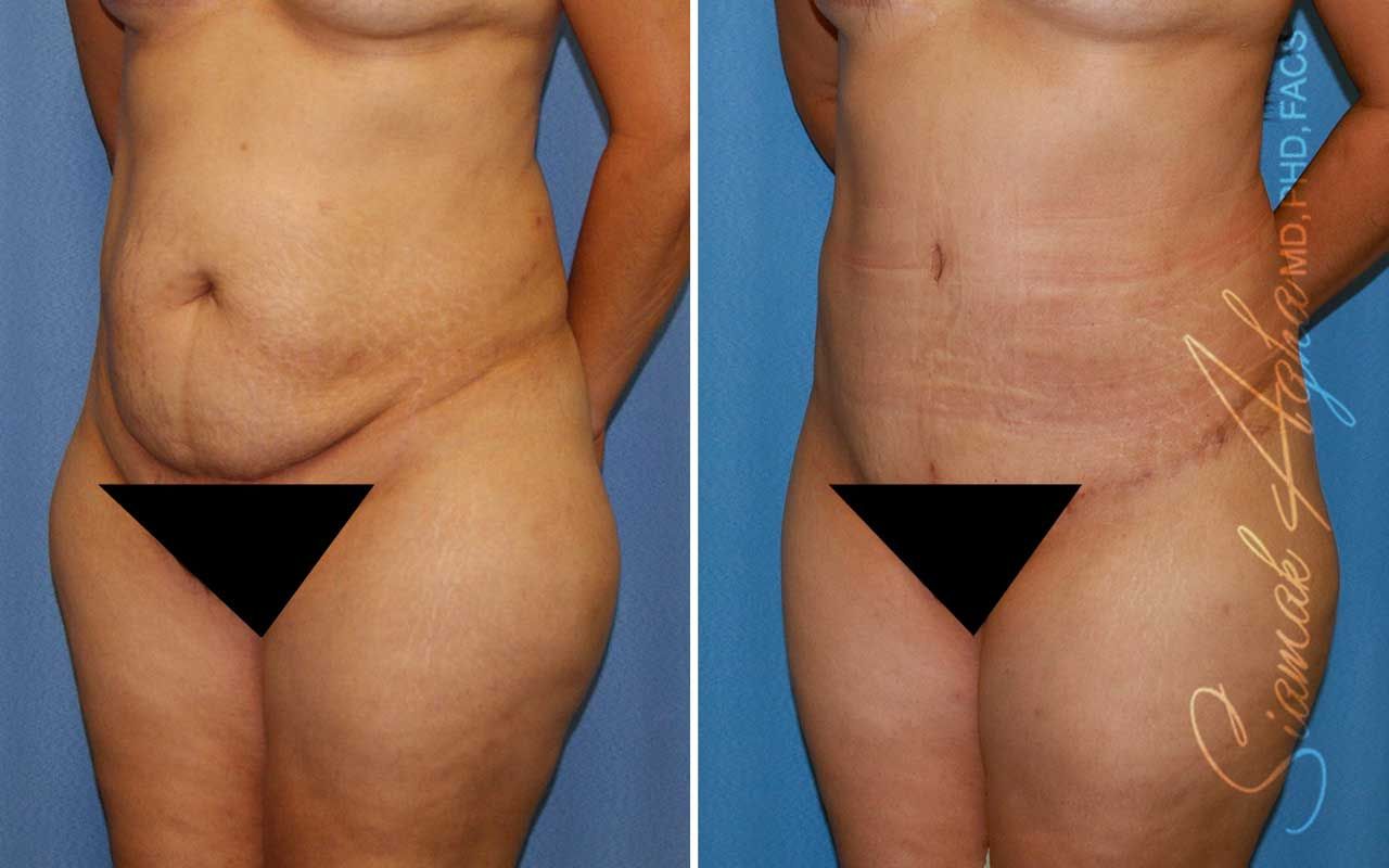 Partial Tummy Tuck Before & After