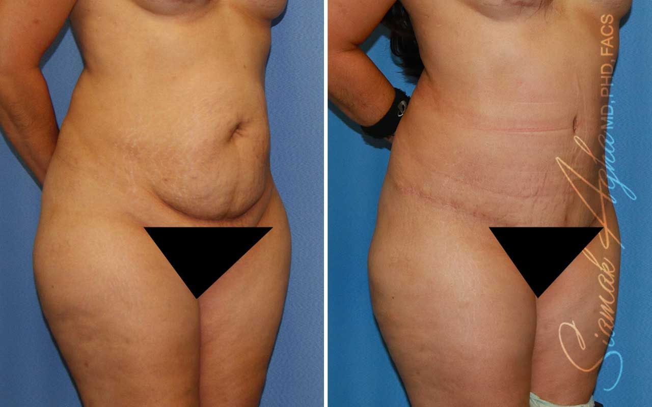Partial Tummy Tuck Before & After