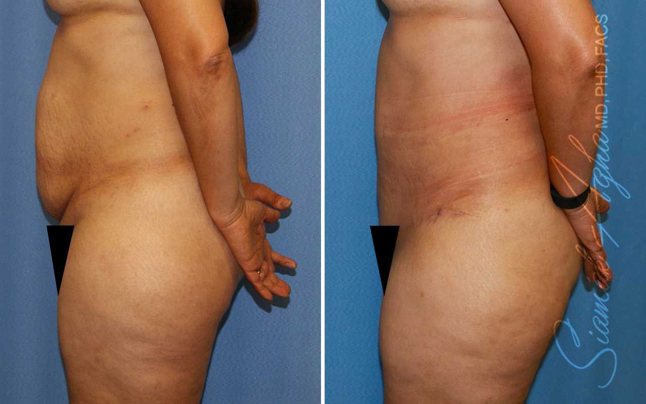 Partial Tummy Tuck Before & After