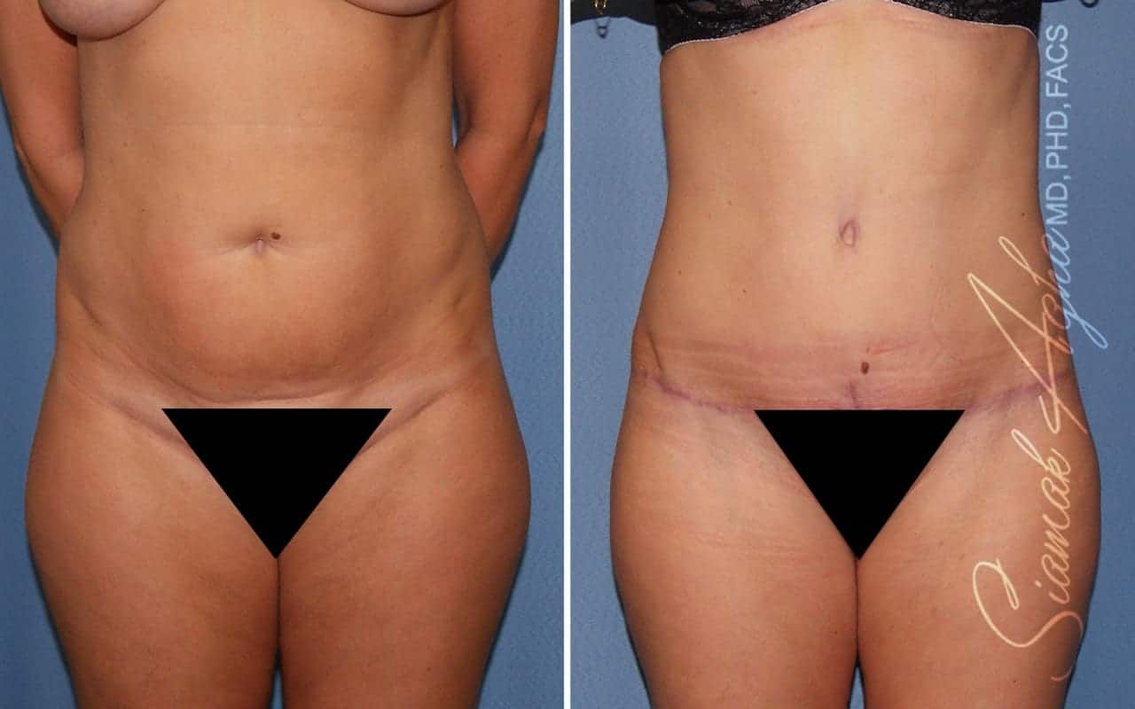 Partial Tummy Tuck Before & After