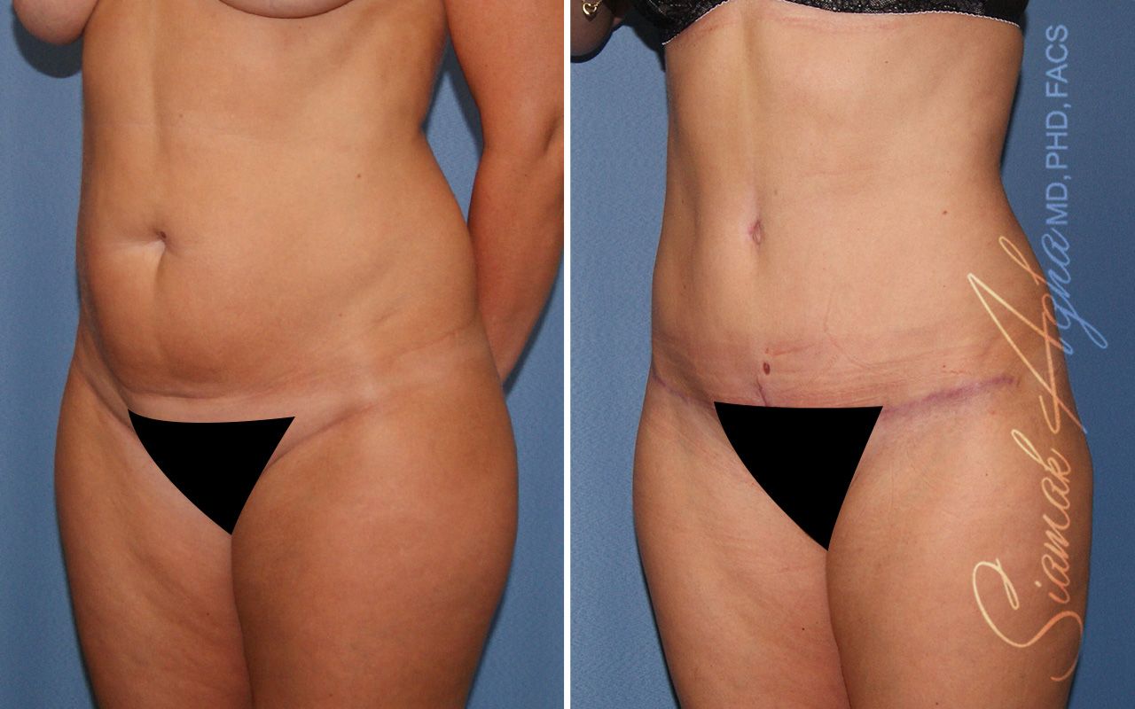 Partial Tummy Tuck Before & After