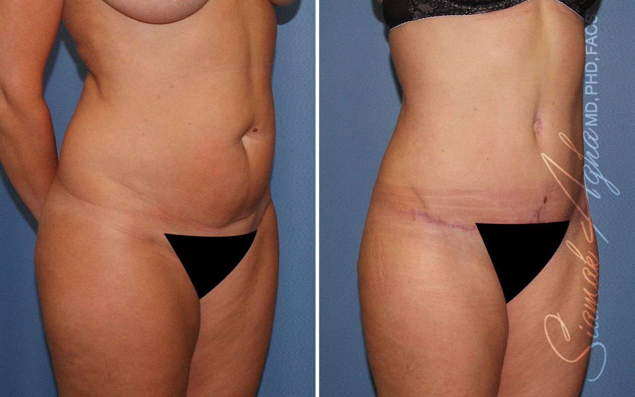 Partial Tummy Tuck Before & After