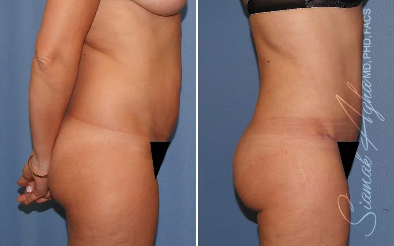 Partial Tummy Tuck Before & After