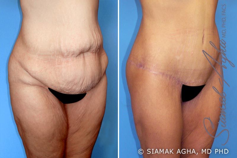Spiral Thigh Lift Before & After