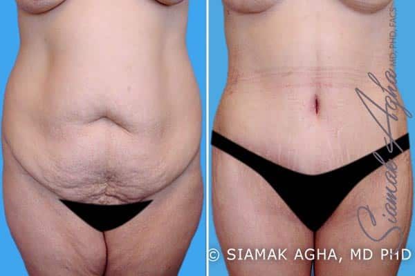 Spiral Thigh Lift Before & After