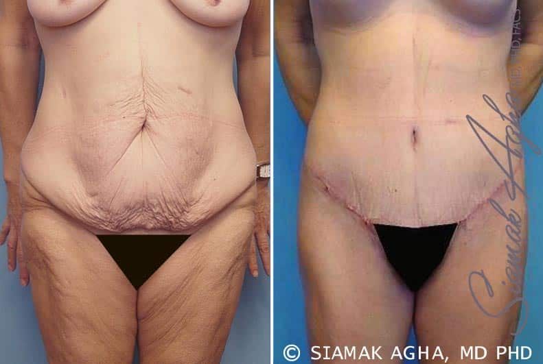 Spiral Thigh Lift Before & After