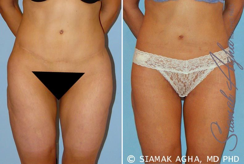 Spiral Thigh Lift Before & After