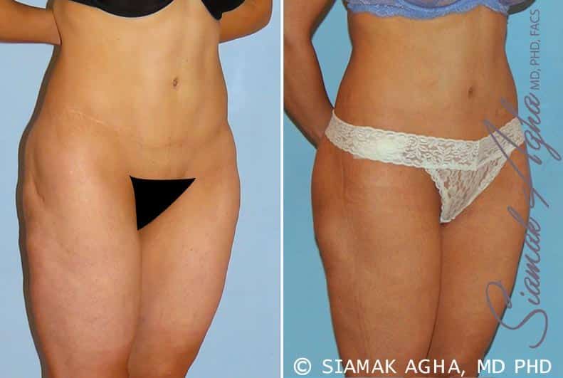 Spiral Thigh Lift Before & After