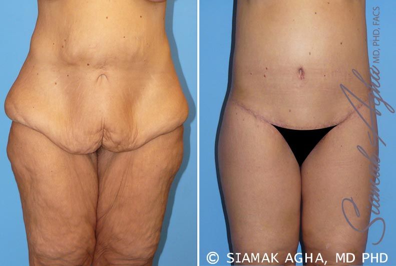 Spiral Thigh Lift Before & After