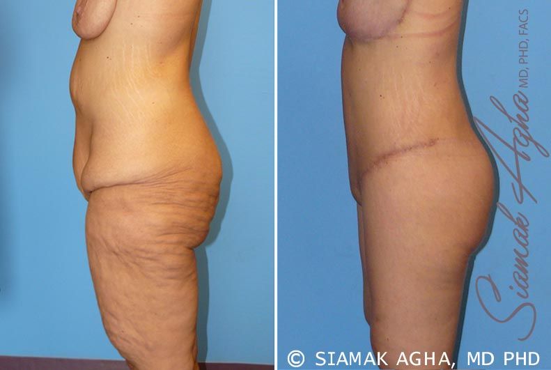 Spiral Thigh Lift Before & After