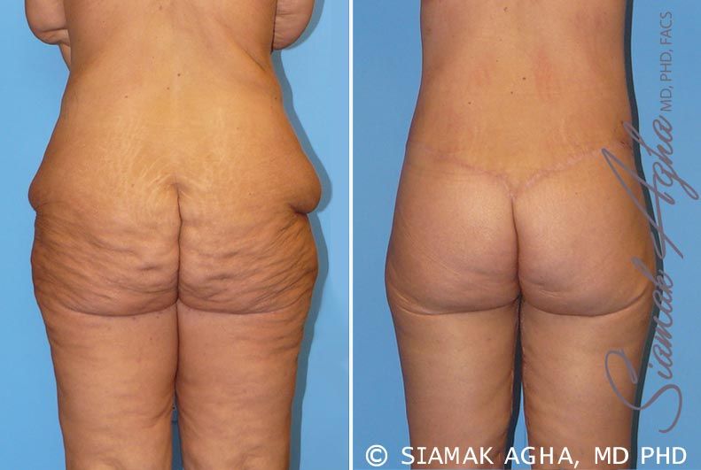 Spiral Thigh Lift Before & After