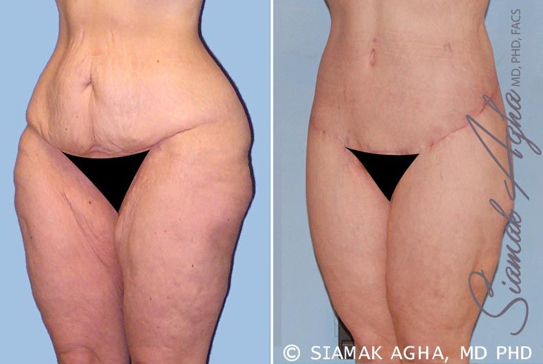 Spiral Thigh Lift Before & After