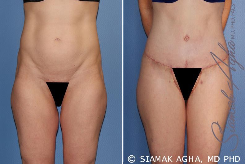 Spiral Thigh Lift Before & After