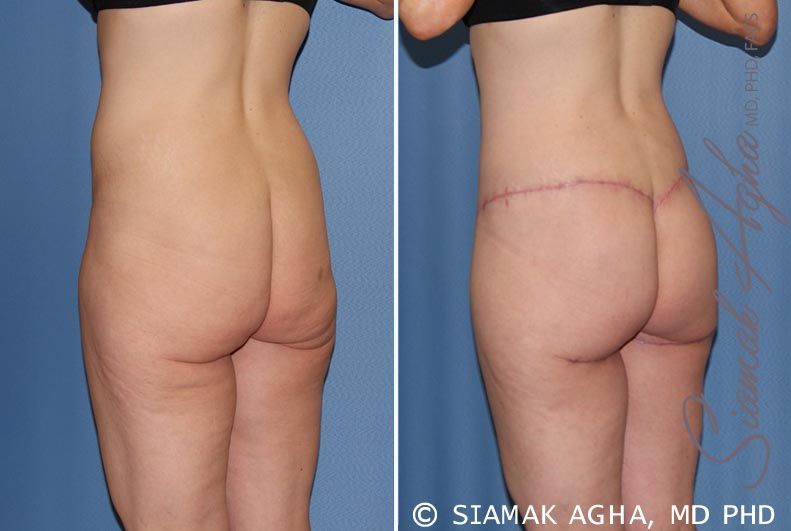 Spiral Thigh Lift Before & After