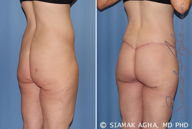 Spiral Thigh Lift Before & After