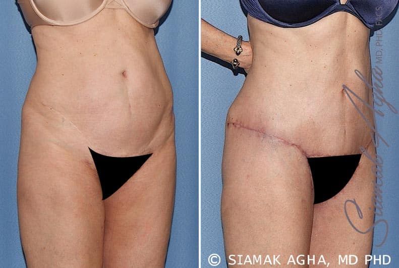 Spiral Thigh Lift Before & After