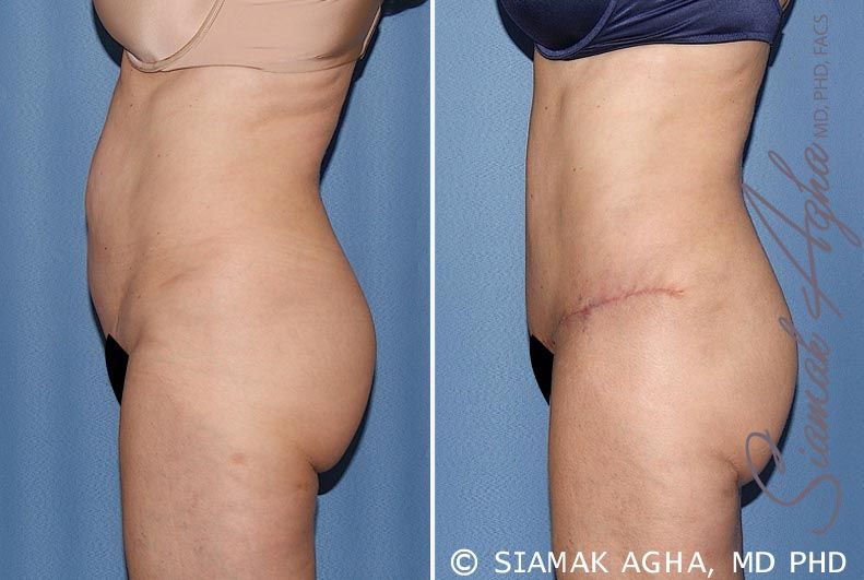 Spiral Thigh Lift Before & After