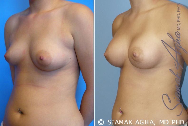 Breast Asymmetry Before & After