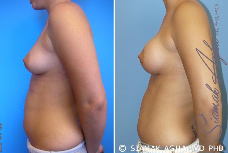 Breast Asymmetry Before & After