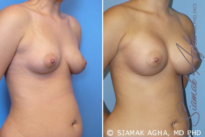 Breast Asymmetry Before & After