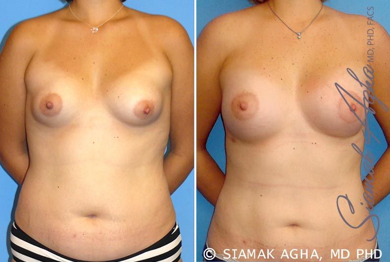 Breast Asymmetry Before & After