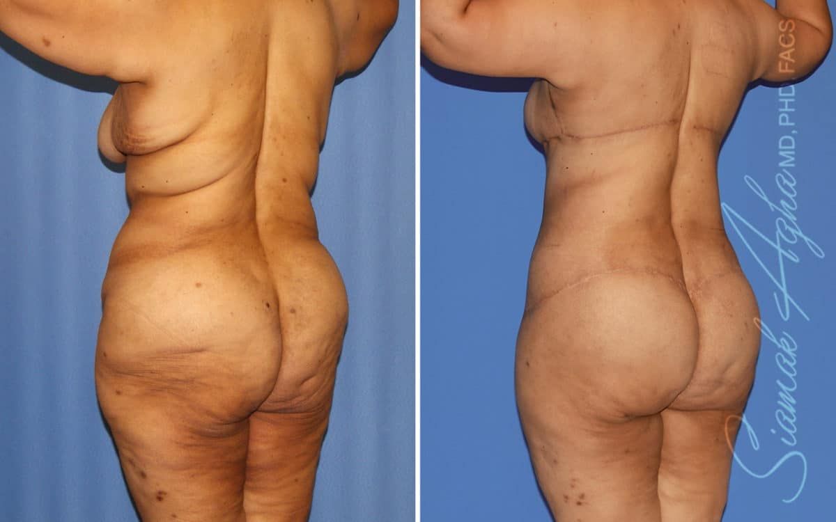 Buttock Reshaping After Weight Loss Before & After