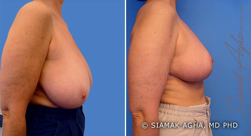 Breast Reduction Before & After